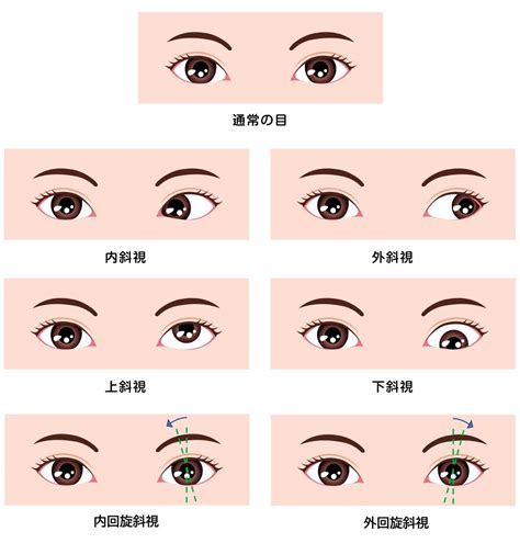 斜視 影響|斜視の症状や原因、治療法とは？ 